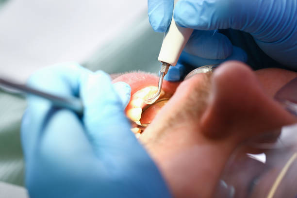 Best Emergency Root Canal Treatment in Dodgeville, WI