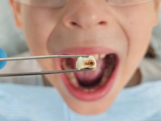 Best Emergency Wisdom Teeth Removal in Dodgeville, WI
